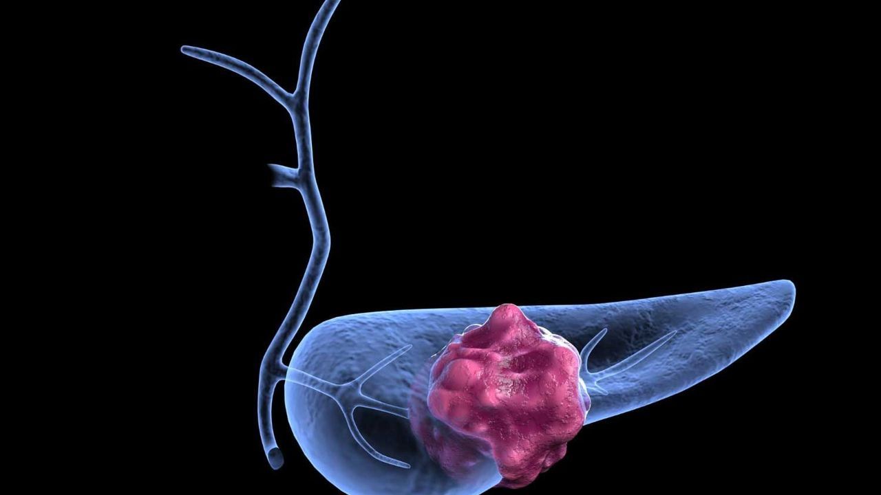 Researchers identify proteins linked to pancreatic cancer