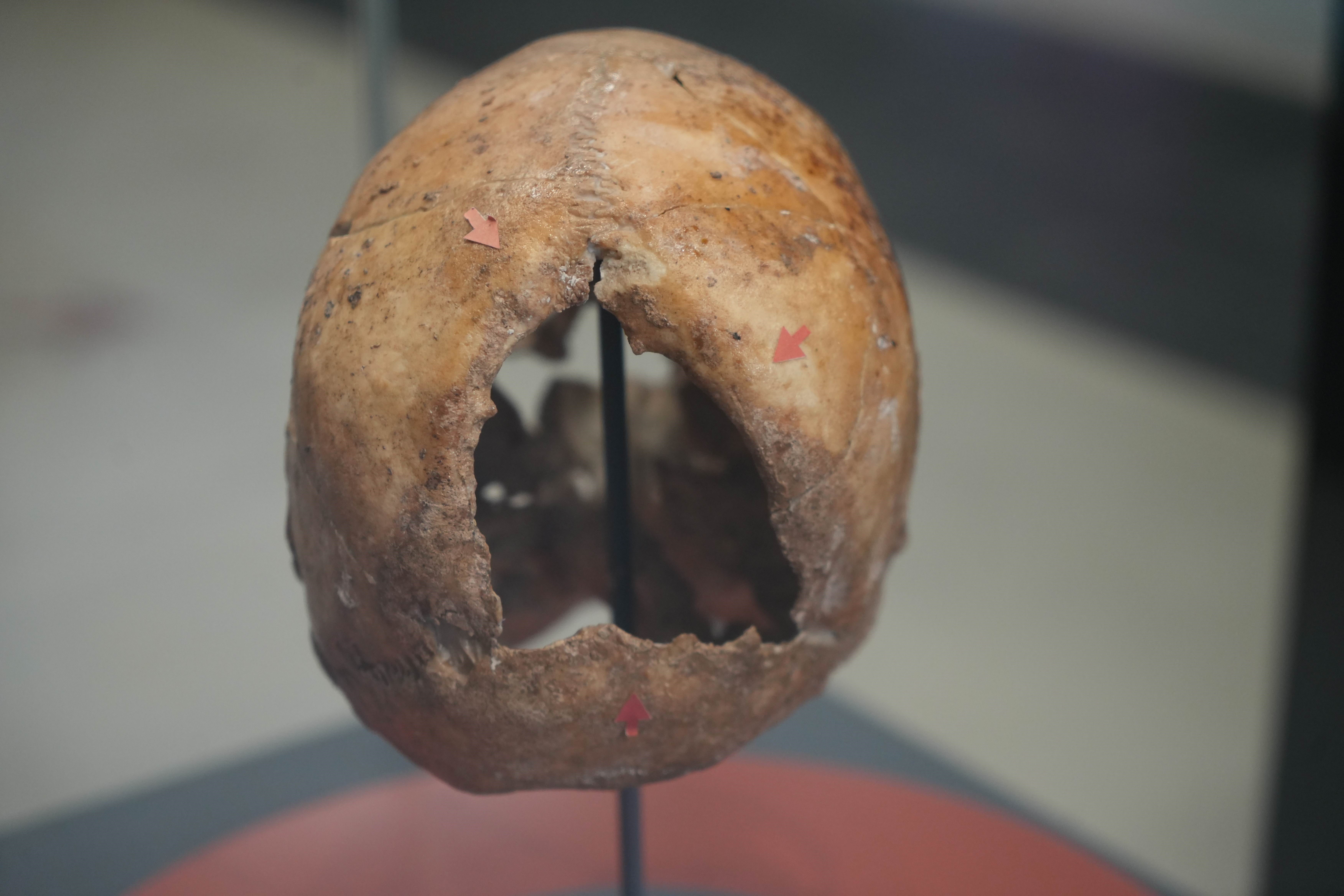 Anatolian skull operated on 5,000 years ago attracts attention