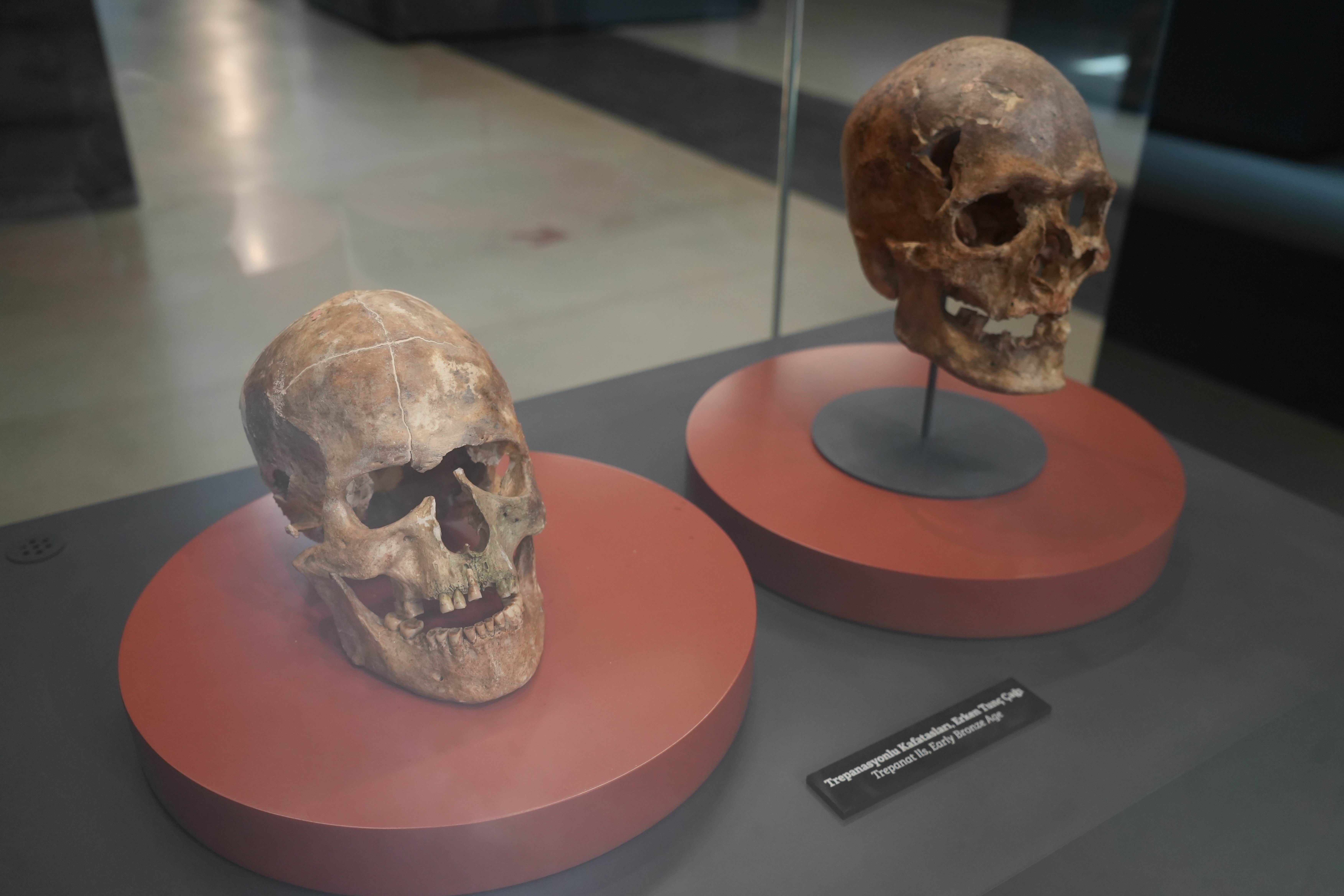 Anatolian skull operated on 5,000 years ago attracts attention