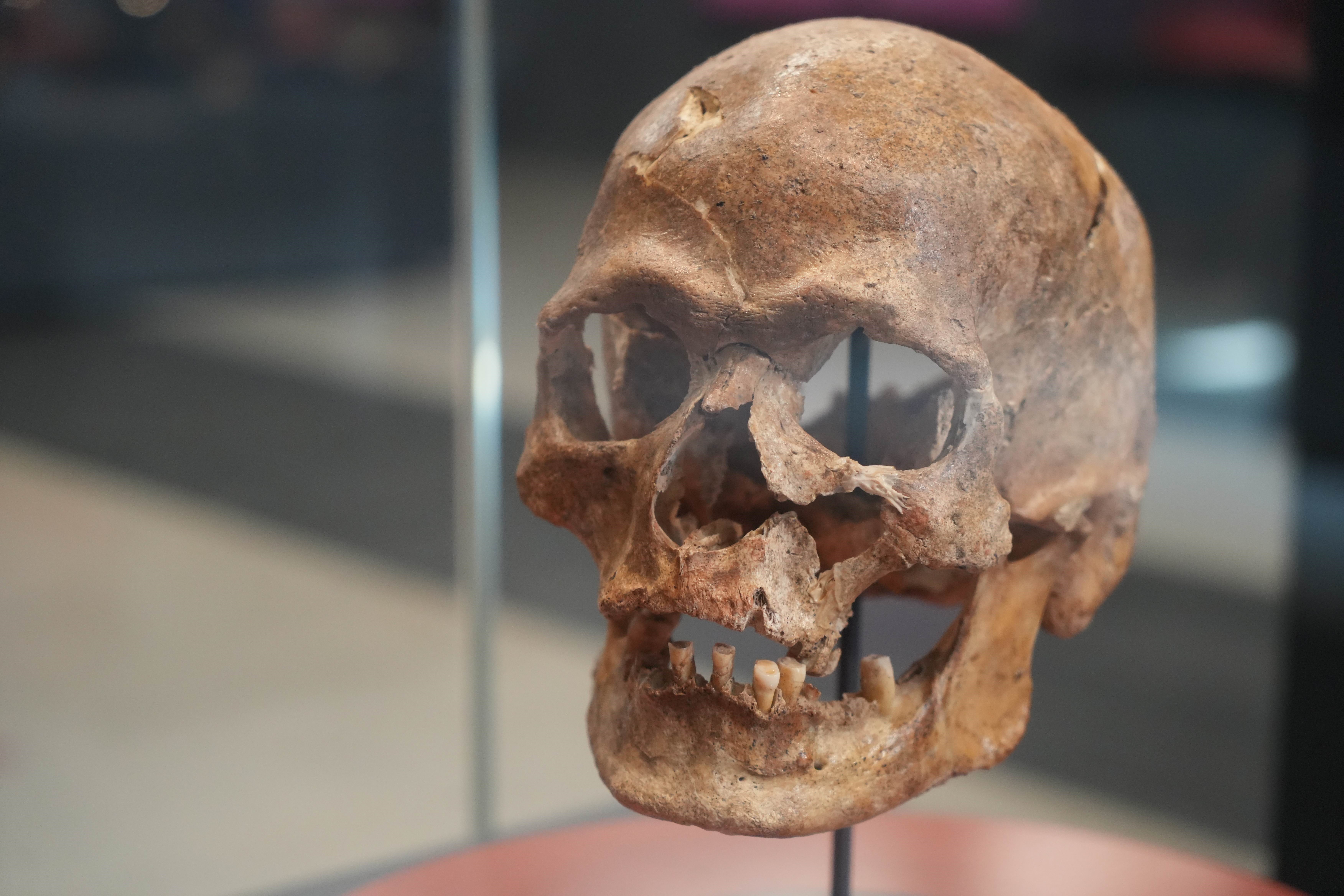 Anatolian skull operated on 5,000 years ago attracts attention